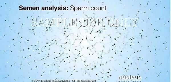  Semen Analysis (Sperm Count)